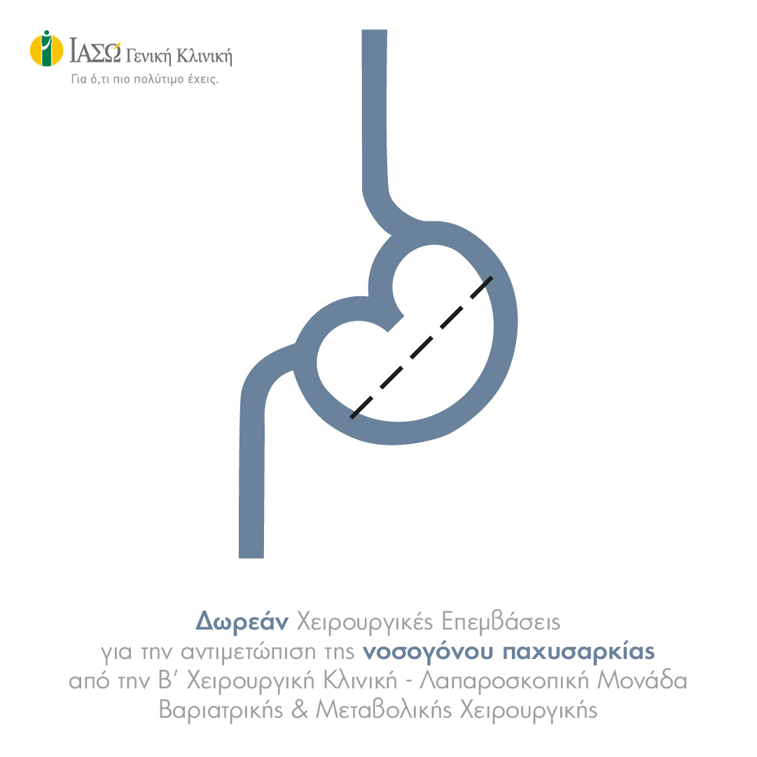 ΙΑΣΩ Γενική Κλινική: Δωρεάν Χειρουργικές Επεμβάσεις για την αντιμετώπιση της Νοσογόνου Παχυσαρκίας